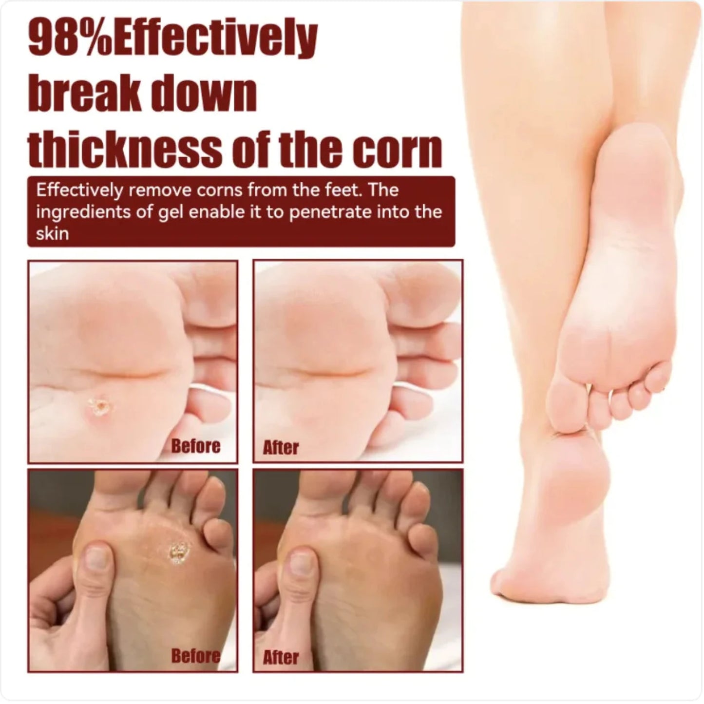 Foot Corn Removal Skin Smoothing Exfoliating Gel for Foot Corns & Repair